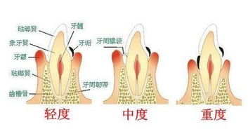 牙槽骨整形大概需要多少钱