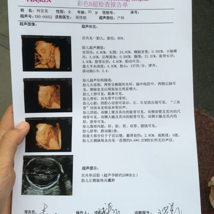 24周胎儿四维彩超未见鼻骨，鼻骨最迟多少