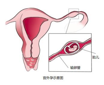 怀孕8周妊娠囊多大正常值