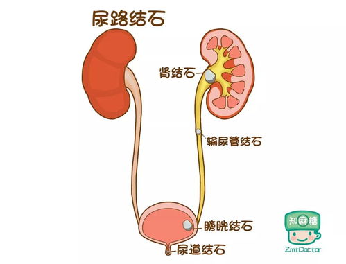 孕妇可以做尿路支架手术吗