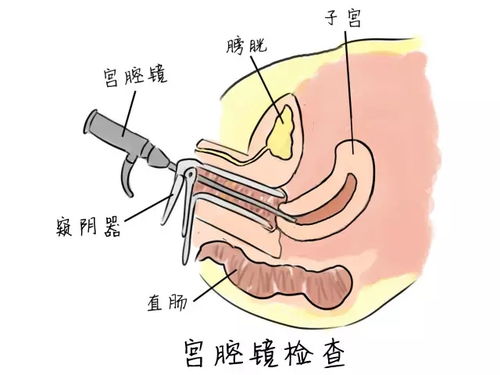 宫腔镜手术后出血多久正常