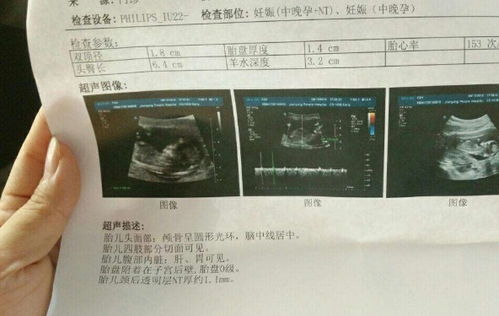 来手把手教你看懂孕检b超单