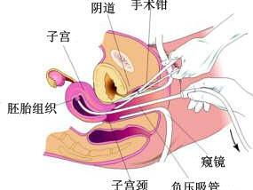 宫腔积液是什么引起的呢