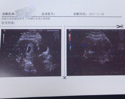 怀孕7周能未见卵黄囊正常吗