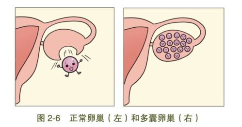 多囊备孕成功经验分享