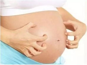 哪些孕妇容易长妊娠纹呢