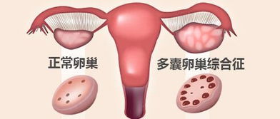 多囊卵巢综合征怎么判定