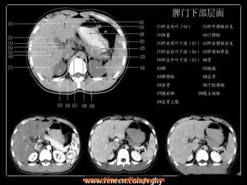 做一个腹部增强CT多少钱