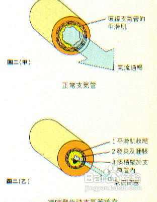 支气管哮喘的治疗