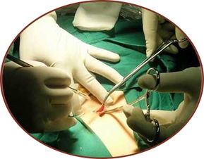 宫外孕腹腔镜手术过程图