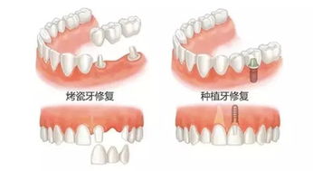 假牙上的套是什么金属做的，有毒吗??