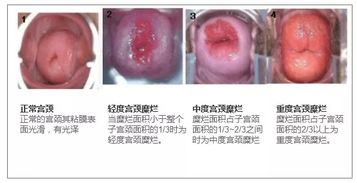 中度宫颈糜烂的症状是什么