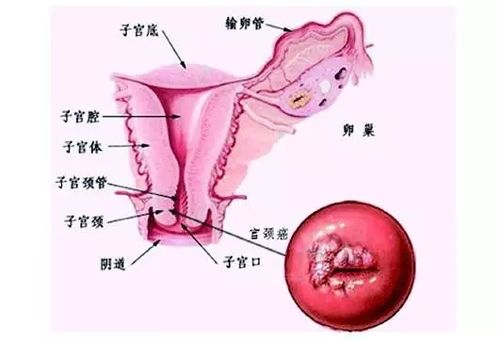 宫颈刮片一天后同房的危害