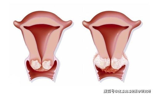 女性尖锐性湿疣怎么传染的