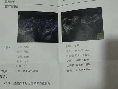 卵黄囊能确定双胞胎吗图片