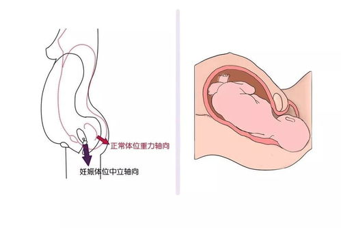 生完孩子是顺产的，可是盆底肌重度损伤怎么治