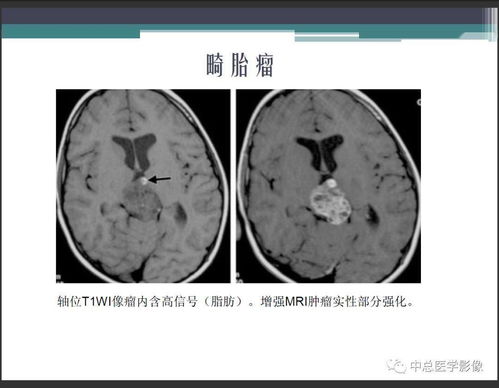 生殖细胞瘤还能治好吗？