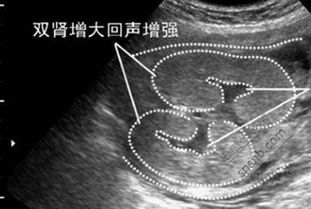 双肾盂分离是生男孩吗