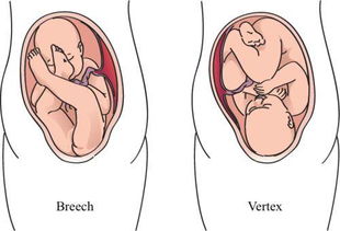 怀孕35周胎位还会不正吗
