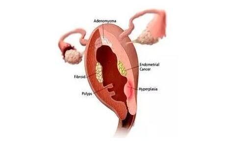 怎样抑制子宫内膜息肉复发