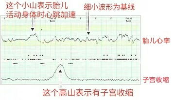 【胎心】胎心监护图怎么看