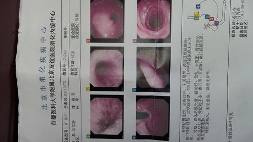 卵黄囊过大是什么原因引起的