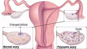 多囊卵巢怎么调理才能好