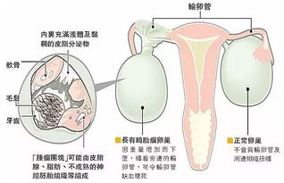 疝气会肚子疼吗?