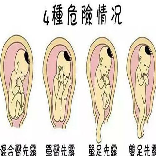 怀孕32周+4天胎儿彩超图