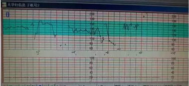 胎心监护图怎么看