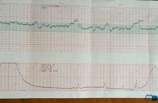 胎心监护图怎么看