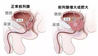 前列腺广告语