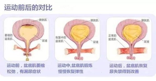 怎么做盆底肌肉练习