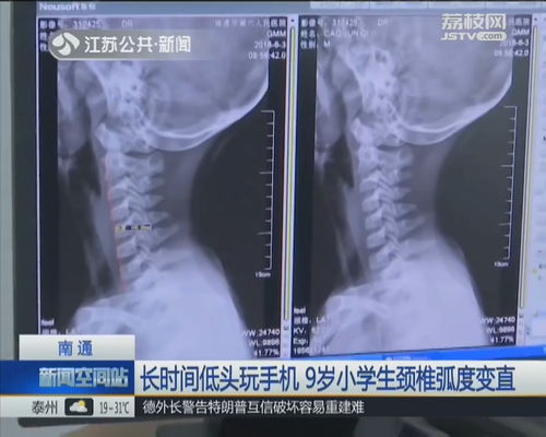 宫外孕保守治疗后出血需多长时间才停止？