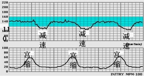 胎心监护显示胎心不稳定是怎么回事