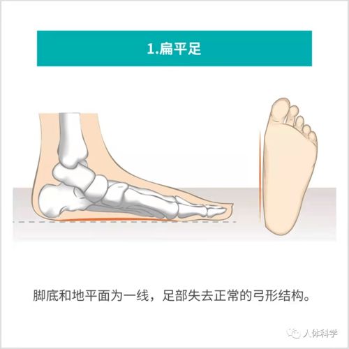 子宫腺肌症