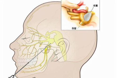 子宫腺肌症