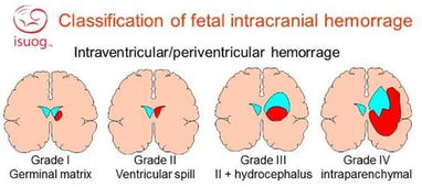 新生儿患颅内出血有哪些症状表现