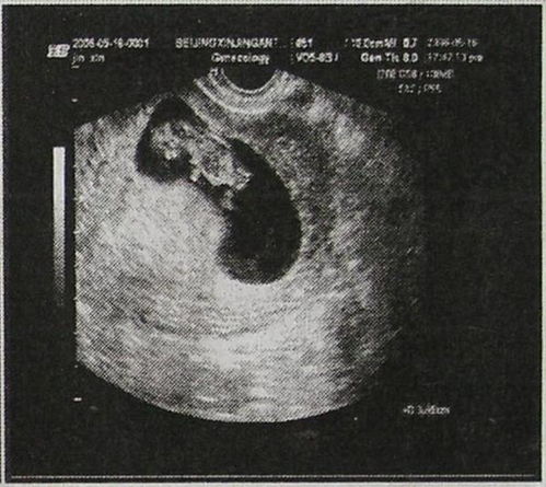孕7周大约3.2x2.8x1.8cm其内卵黄囊并可见胎芽及原始胎心管博动，胎芽0.8cm