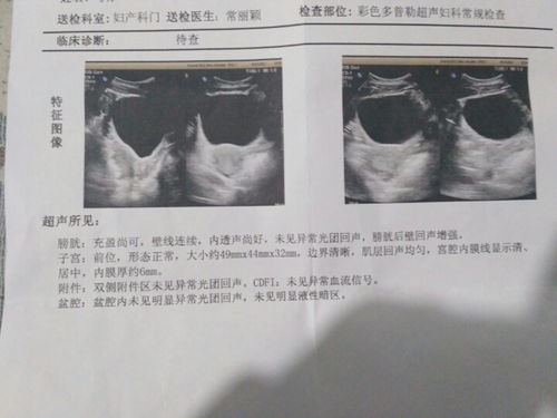 多囊有必要检查甲状腺吗