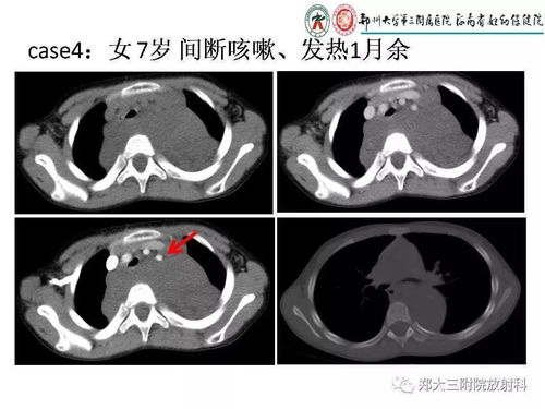 纵隔肿瘤有什么症状