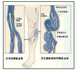 孕期静脉曲张是什么样子的