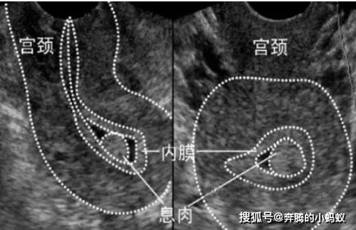 孕囊内见血流信号显示是什么意思