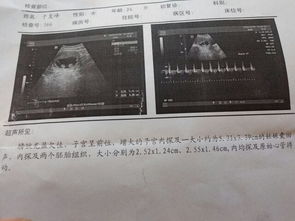 同卵双胞胎的几率是多少