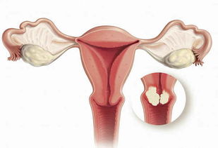 24岁为什么会得卵巢囊肿呢