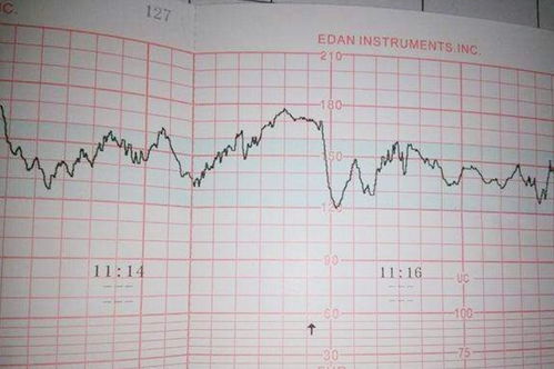 胎心检测，胎心一直偏高怎么办