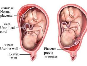 边缘性前置胎盘剖腹产有危险吗