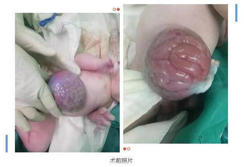 请问肠管有轻度扩张是什么意思