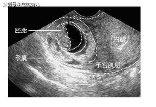 我怀孕11周检查有胎芽无胎心