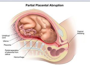 胎盘早剥会影响胎儿吗